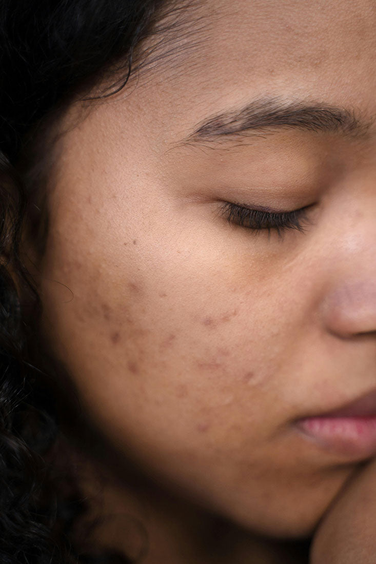 Acné, eczéma, teint terne : et si c’était votre microbiote ?